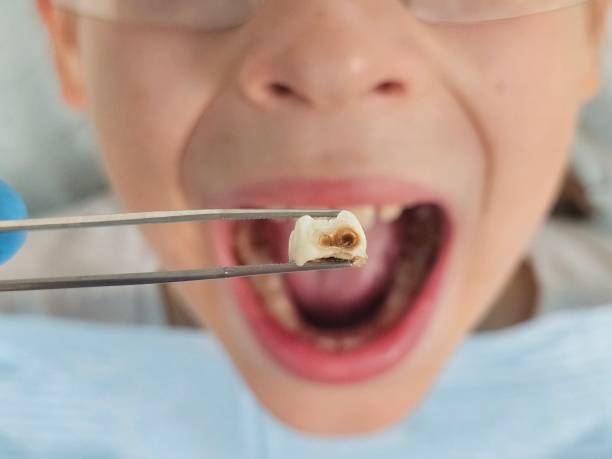 Best Emergency Treatment for Dental Infections or Abscesses in Pea Ridge, AR